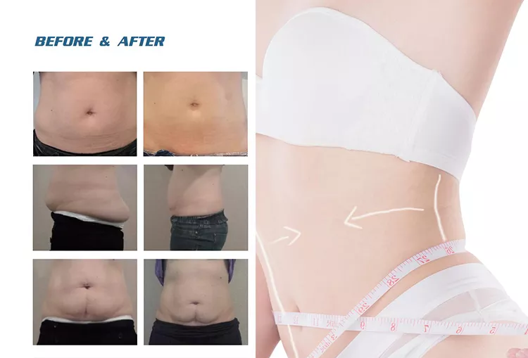 Vente en usine 2022 Machine d''amincissement par cryolipolyse 360 / Machine de refroidissement des graisses Cool Tech Réduction de la cellulite