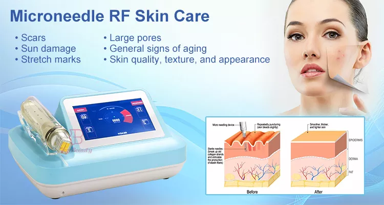 Appareil de microneedling fractionné RF à microneedles