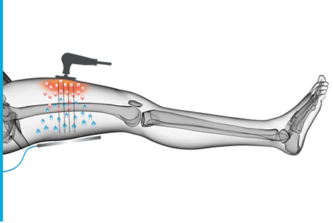 Appareil de physiothérapie Tecar 2.1, thérapie CET RET RF pour le soulagement de la douleur, appareil de physiothérapie intelligent 448khz Tecar