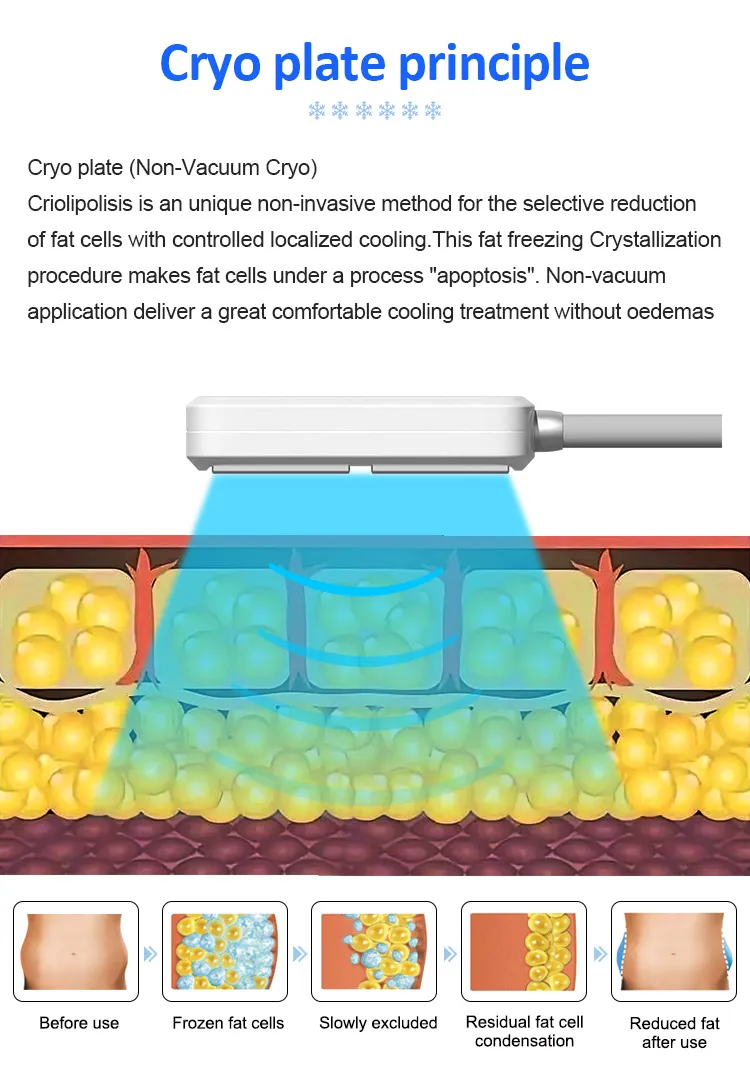 Appareil portable de cryolipolyse pour maigrir et éliminer la cellulite, plaques cryo avec EMS