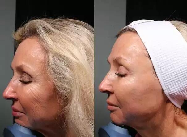 Machine de beauté à ultrasons focalisés de haute intensité pour lifting facial et suppression des rides, amincissement du corps, Vmax HIFU 8D