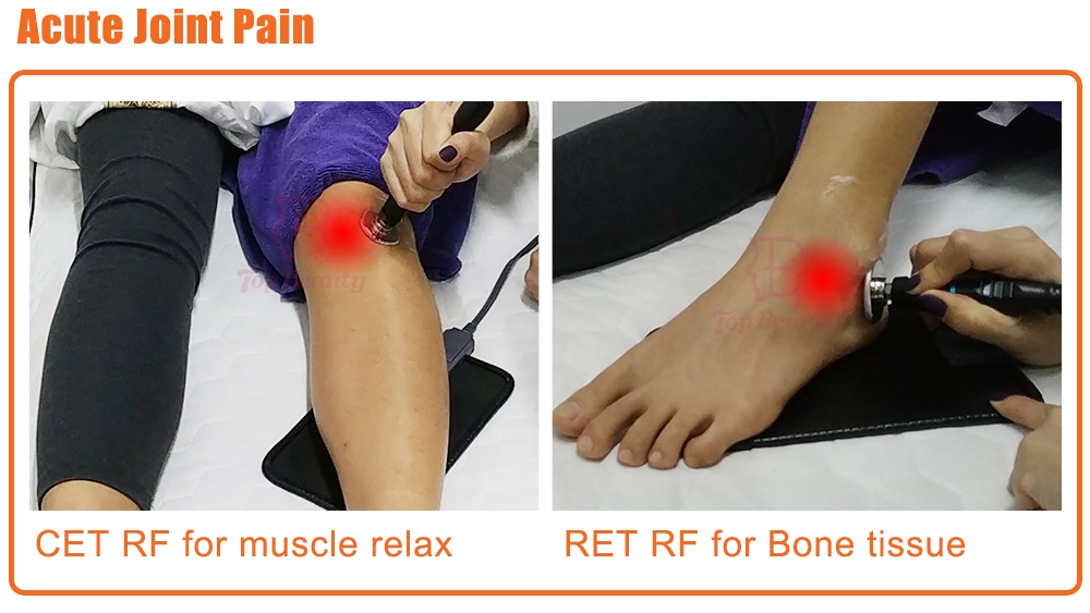 Thérapie Tecar Physio Machine RF Monopolaire Résistive et Capacitive Tecarterapia Professionnelle