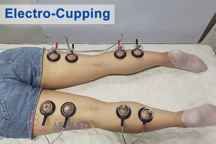 Stimulateur musculaire EMS pour l''amincissement du corps, machine de thérapie par électrostimulation à ondes russes et cupping mammaire sous vide