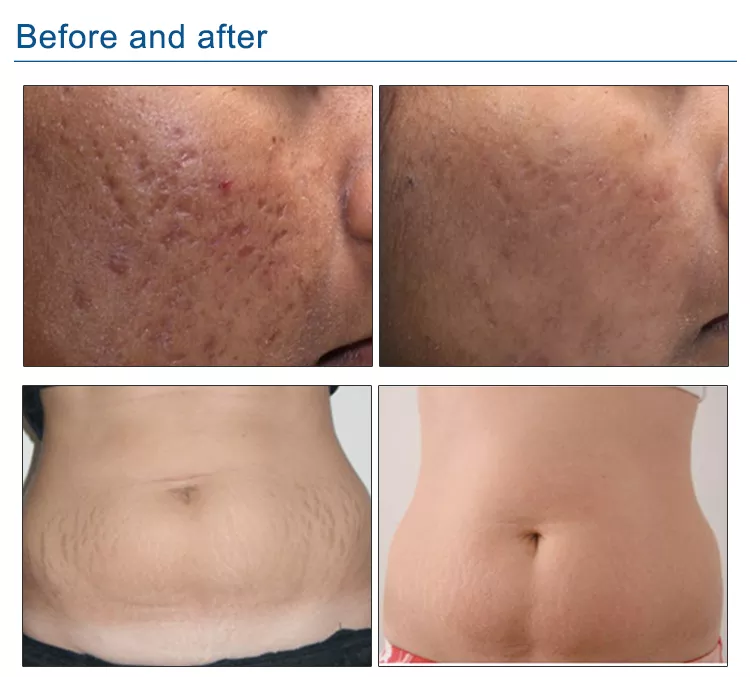Appareil de microneedling fractionné RF à microneedles
