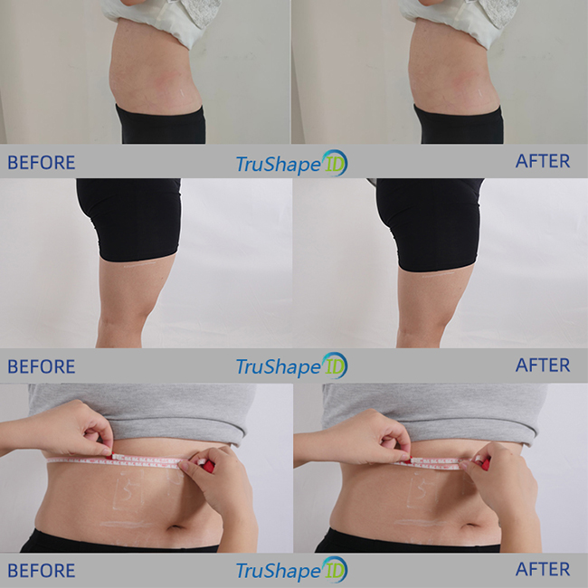 Machine de Traitement Trushape ID Ems Stimulation Électrique des Muscles Sculpture Corporelle Emslim