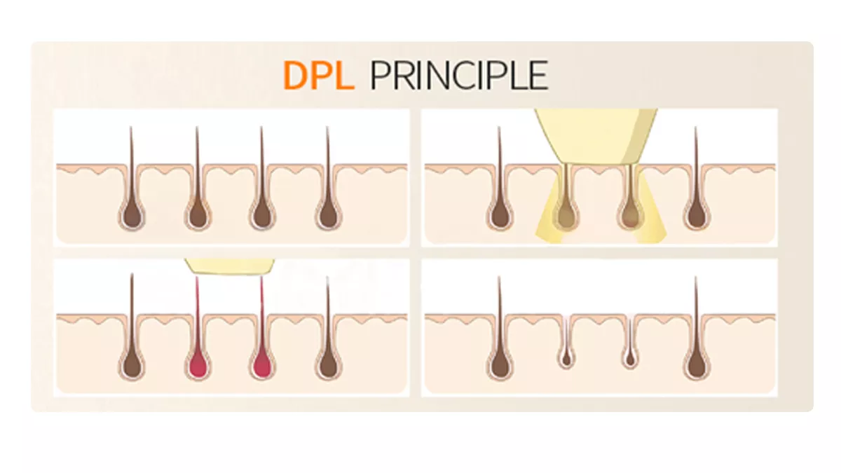 Machine de dépilation à diode DPL, rajeunissement de la peau, lifting anti-rides et machine de beauté