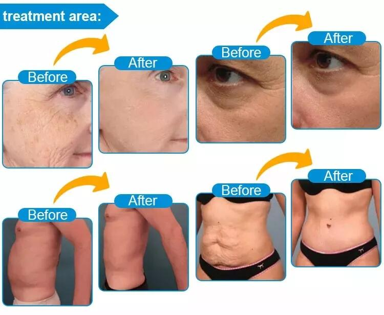 Machine de beauté à ultrasons focalisés de haute intensité pour lifting facial et suppression des rides, amincissement du corps, Vmax HIFU 8D