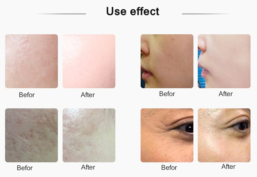 Appareil de soins de la peau à injection de mésothérapie RF à micro-aiguilles à ultrasons
