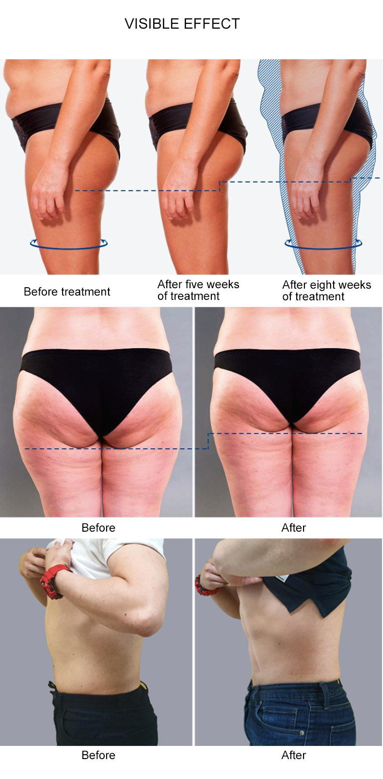 Appareil de thérapie par ondes de choc et RF SMAS 2 en 1 pour la cellulite