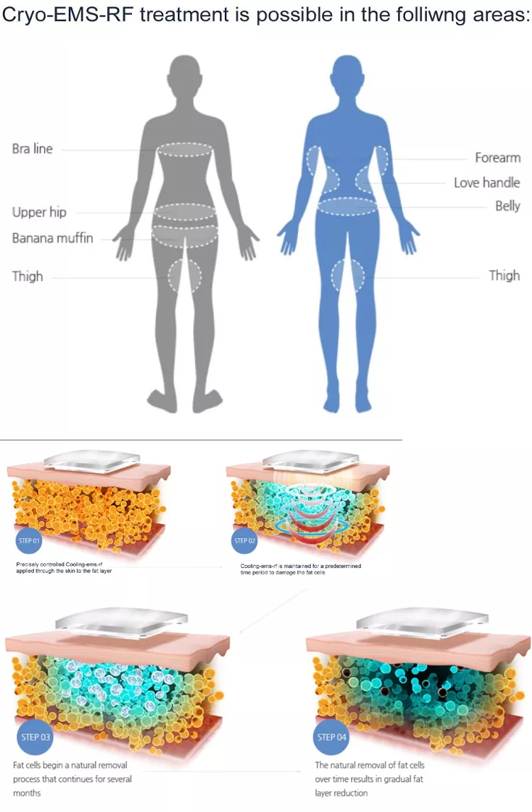 Appareil de cryolipolyse pour perte de graisse 2023 nouveau avec coussinets cryo pour maigrir Machine de cryolipolyse Coldtec