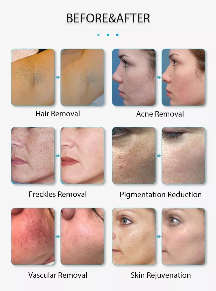 Nouvelle machine d''épilation à lumière pulsée intense de type IPL