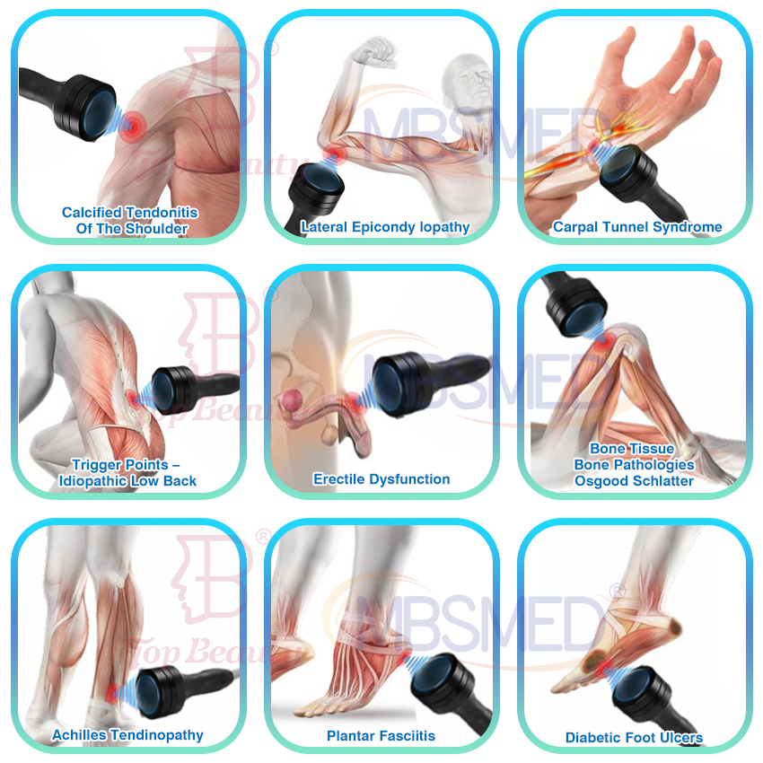 Vente chaude système de choc eswt ed focus shockwave, machine de thérapie par choc ciblé, Shockwave Physique