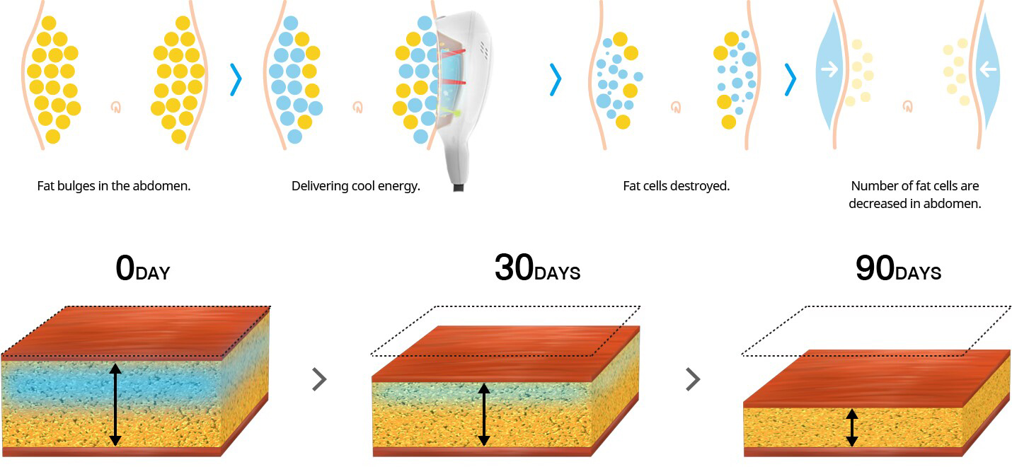 Meilleur prix machine de cryolipolyse pour maigrir cryothérapie perte de poids graisse congelée