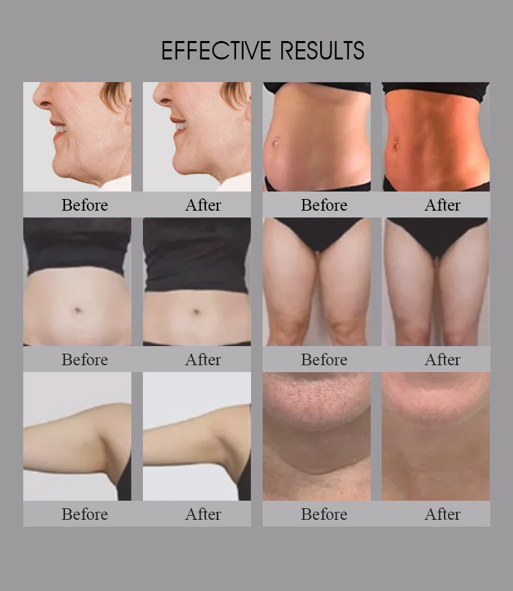 Appareil 3 en 1 pour salon utilisant Trusculpt Id Flex Rf pour le contournement du corps et la sculpture corporelle, traitement de la cellulite à 2mhz et réduction des graisses avec la machine Trufat