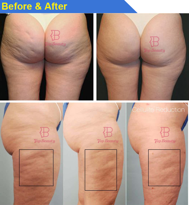 Appareil de massage contre la cellulite à rouleaux Endospheres