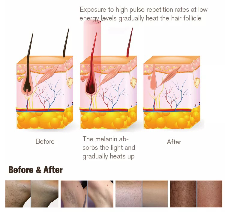 Nouvelle machine d''épilation à lumière pulsée intense de type IPL