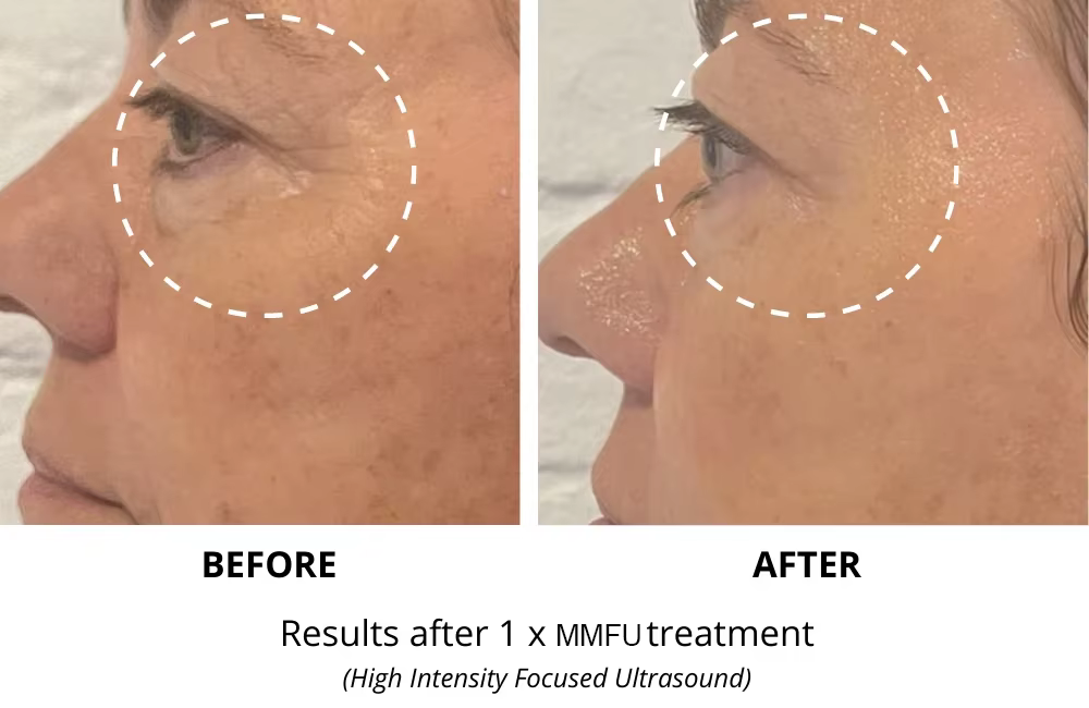 Machine de lifting facial HIFU RF 2 en 1 7D et machine de raffermissement du visage et du corps HIFU