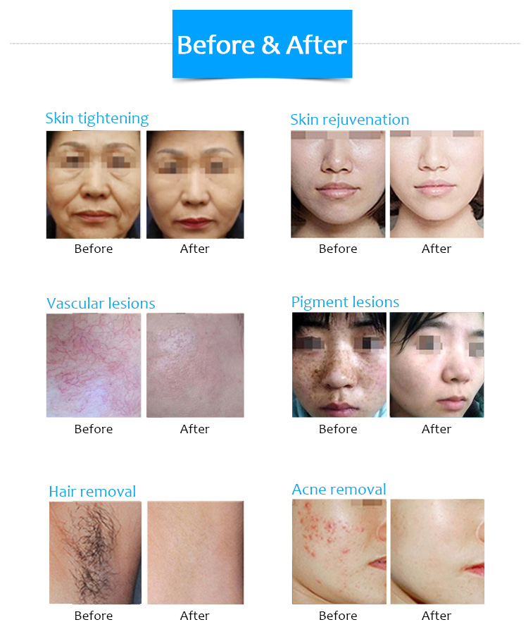 Machine de dépilation à diode DPL, rajeunissement de la peau, lifting anti-rides et machine de beauté