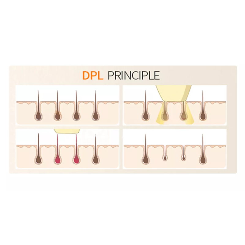 Machine de dépilation à diode DPL, rajeunissement de la peau, lifting anti-rides et machine de beauté