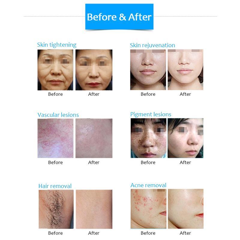 Machine de dépilation à diode DPL, rajeunissement de la peau, lifting anti-rides et machine de beauté