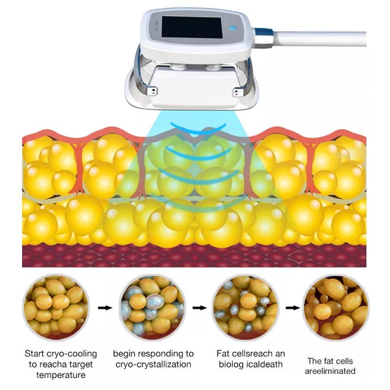 Machine de cryolipolyse 360 Cryo 2022 au meilleur prix pour perte de poids par cryolipolyse