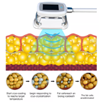Machine de cryolipolyse 360 Cryo 2022 au meilleur prix pour perte de poids par cryolipolyse
