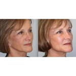 Machine de radiofréquence Mmfu Cyclone Rf Lifting facial indolore Machine Rf pour raffermir la peau et supprimer les rides