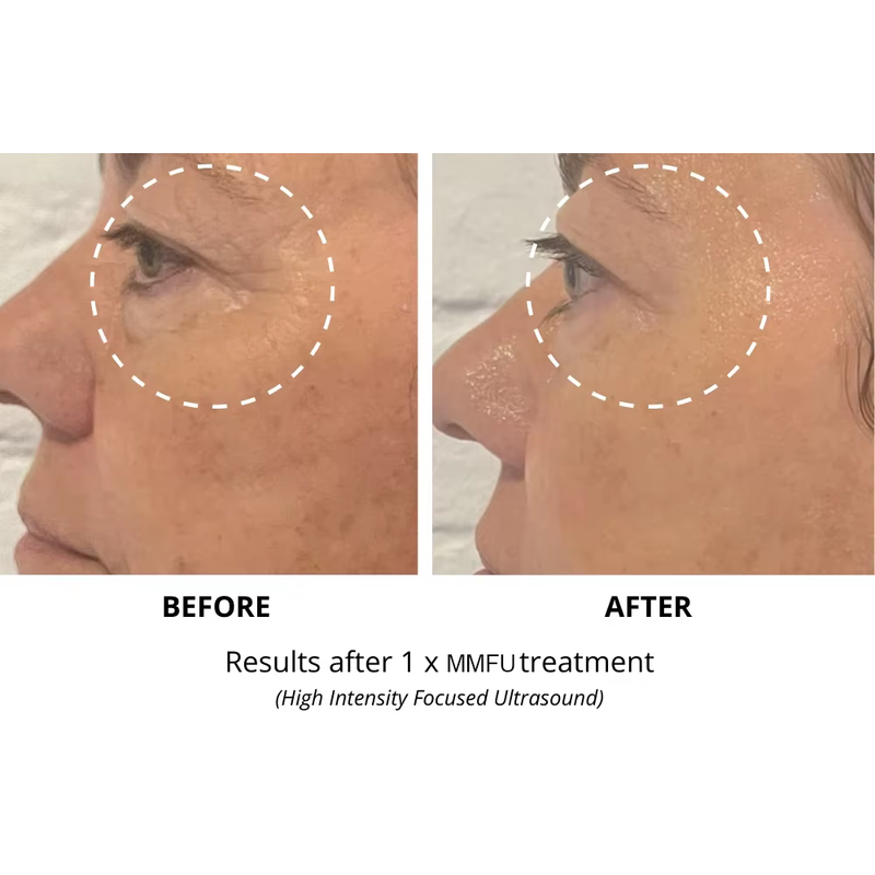 Machine de lifting facial HIFU RF 2 en 1 7D et machine de raffermissement du visage et du corps HIFU