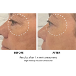 Machine de lifting facial HIFU RF 2 en 1 7D et machine de raffermissement du visage et du corps HIFU