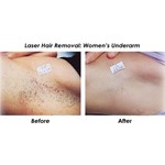 Nouvelle machine d''épilation à lumière pulsée intense de type IPL