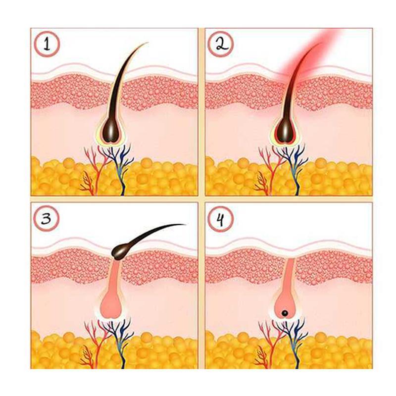 Nouvelle machine d''épilation à lumière pulsée intense de type IPL