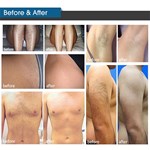 Nouvelle machine d''épilation à lumière pulsée intense de type IPL