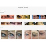 Appareil de levage des yeux au plasma pour la beauté Machine de traitement de