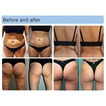 Machine de réduction de cellulite à rouleau infrarouge sous vide 5D
