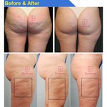 Appareil de massage contre la cellulite à rouleaux Endospheres