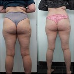 Machine de drainage lymphatique Endosphère pour le remodelage corporel avec rouleau à billes internes pour massage musculaire et réduction de la cellulite